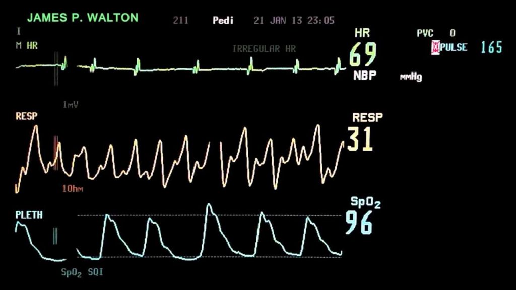 ekg monitor